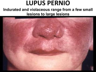 LUPUS PERNIO
Indurated and violaceous range from a few small
lesions to large lesions
 