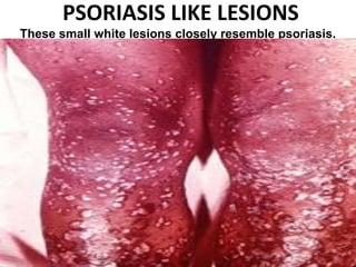 PSORIASIS LIKE LESIONS
These small white lesions closely resemble psoriasis.
 
