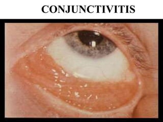 CONJUNCTIVITIS
 
