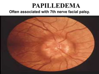 PAPILLEDEMA
Often associated with 7th nerve facial palsy.
 