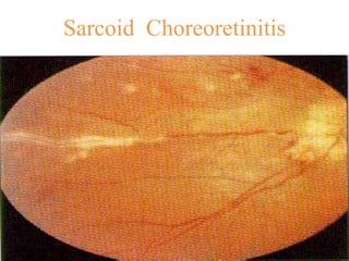 Sarcoid Choreoretinitis
 