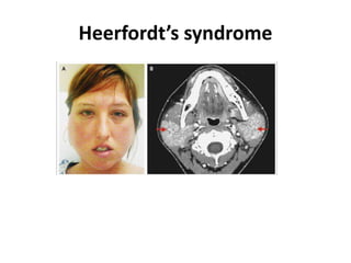 Heerfordt’s syndrome
 