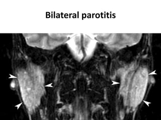 Bilateral parotitis
 