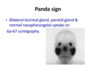 Panda sign
• Bilateral lacirmal gland, parotid gland &
normal nasopharyngelal uptake on
Ga-67 scintigraphy.
 