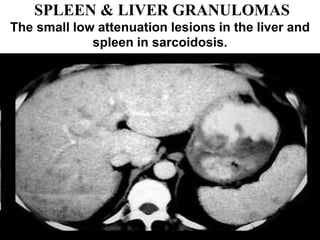 SPLEEN & LIVER GRANULOMAS
The small low attenuation lesions in the liver and
spleen in sarcoidosis.
 