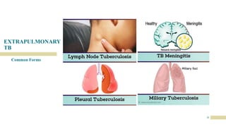 EXTRAPULMONARY
TB
13
Common Forms
 