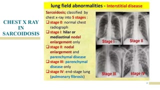 CHEST X RAY
IN
SARCOIDOSIS
17
 