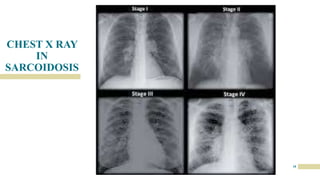 CHEST X RAY
IN
SARCOIDOSIS
18
 