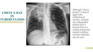 CHEST X RAY
IN
TUBERCULOSIS
19
Although “classic
picture” is that of
upper lobe
infiltration &
cavities, virtually
any radiographic
pattern from a
normal film or a
solitary pulmonary
nodule to diffuse
alveolar infiltrates
may be seen
 