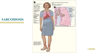 SARCOIDOSIS
6
 