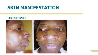 MM.DD.20XX
ADD A FOOTER
7
SKIN MANIFESTATION
LUPUS PERNIO
 