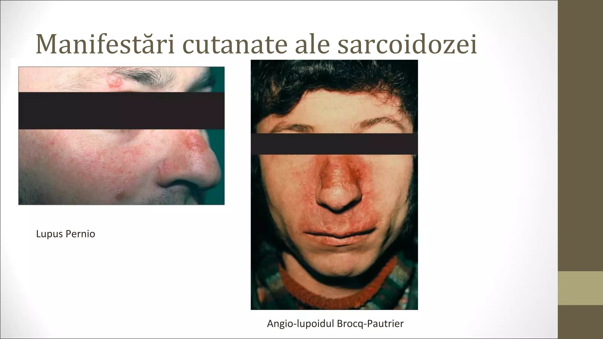 Manifestări cutanate ale sarcoidozei
Lupus Pernio
Angio-lupoidul Brocq-Pautrier
 