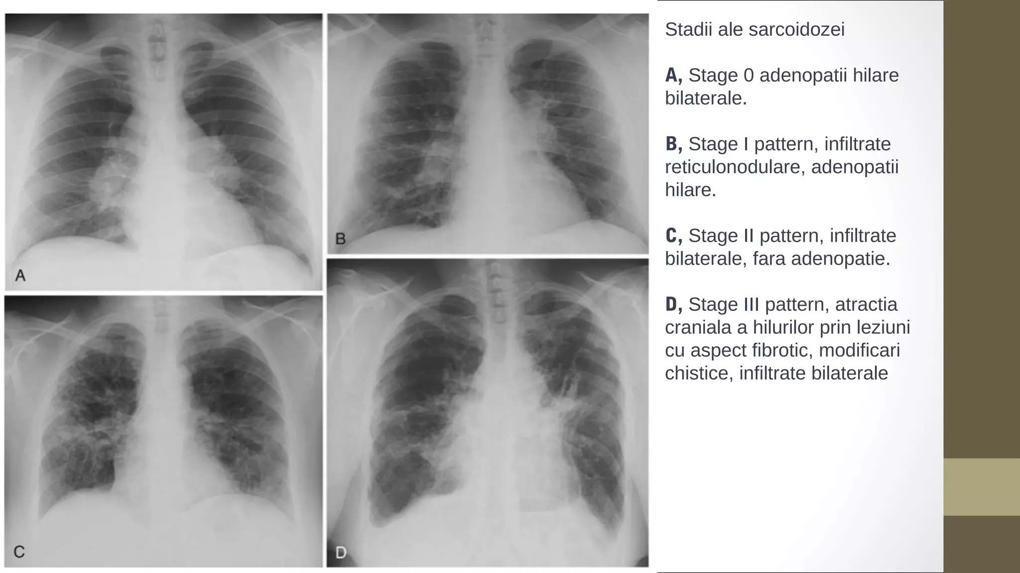 Stadii ale sarcoidozei
A, Stage 0 adenopatii hilare
bilaterale.
B, Stage I pattern, infiltrate
reticulonodulare, adenopatii
hilare.
C, Stage II pattern, infiltrate
bilaterale, fara adenopatie.
D, Stage III pattern, atractia
craniala a hilurilor prin leziuni
cu aspect fibrotic, modificari
chistice, infiltrate bilaterale
 