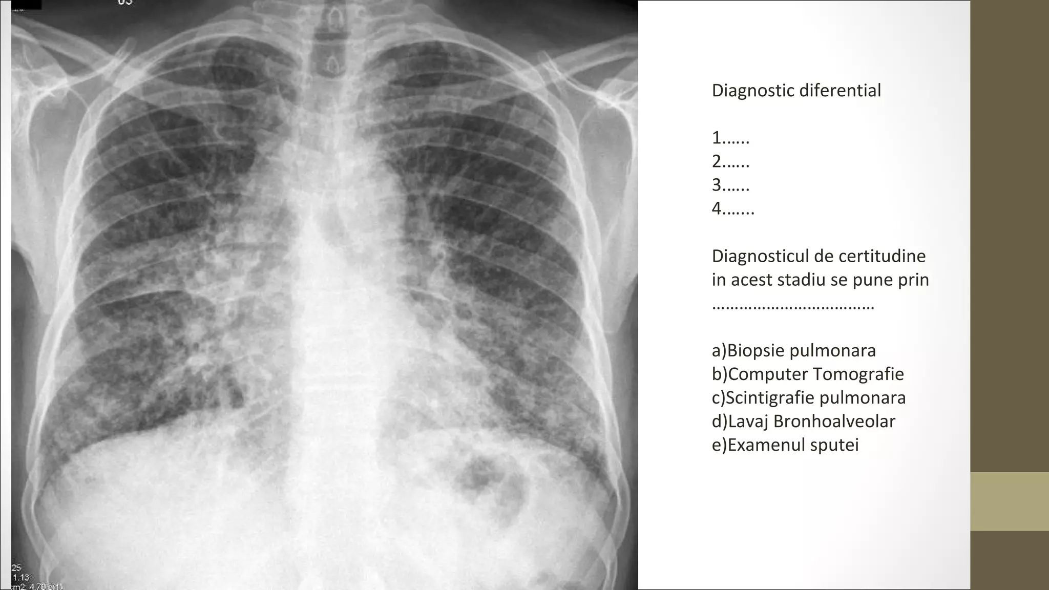 Diagnostic diferential
1.…..
2.…..
3.…..
4.…...
Diagnosticul de certitudine
in acest stadiu se pune prin
………………………………
a)Biopsie pulmonara
b)Computer Tomografie
c)Scintigrafie pulmonara
d)Lavaj Bronhoalveolar
e)Examenul sputei
 