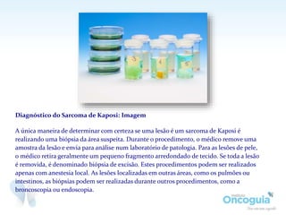 Diagnóstico do Sarcoma de Kaposi: Imagem
A única maneira de determinar com certeza se uma lesão é um sarcoma de Kaposi é
realizando uma biópsia da área suspeita. Durante o procedimento, o médico remove uma
amostra da lesão e envia para análise num laboratório de patologia. Para as lesões de pele,
o médico retira geralmente um pequeno fragmento arredondado de tecido. Se toda a lesão
é removida, é denominado biópsia de excisão. Estes procedimentos podem ser realizados
apenas com anestesia local. As lesões localizadas em outras áreas, como os pulmões ou
intestinos, as biópsias podem ser realizadas durante outros procedimentos, como a
broncoscopia ou endoscopia.
 