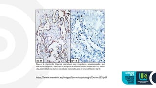 https://www.menarini.es/images/dermatopatologia/Derma135.pdf
 