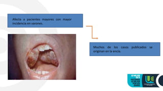 Afecta a pacientes mayores con mayor
incidencia en varones.
Muchos de los casos publicados se
originan en la encía.
 