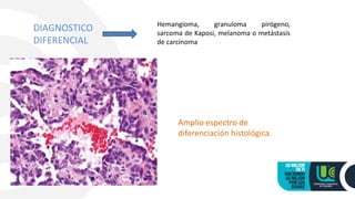 DIAGNOSTICO
DIFERENCIAL
Hemangioma, granuloma pirógeno,
sarcoma de Kaposi, melanoma o metástasis
de carcinoma
Amplio espectro de
diferenciación histológica.
 