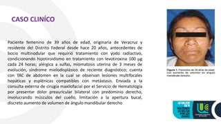 Paciente femenino de 39 años de edad, originaria de Veracruz y
residente del Distrito Federal desde hace 20 años, antecedentes de
bocio multinodular que requirió tratamiento con yodo radiactivo,
condicionando hipotiroidismo en tratamiento con levotiroxina 100 µg
cada 24 horas; alérgica a sulfas, miomatosis uterina de 3 meses de
evolución, síndrome mielodisplásico de reciente diagnóstico; cuenta
con TAC de abdomen en la cual se observan lesiones multifocales
hepáticas y esplénicas compatibles con metástasis. Enviada a la
consulta externa de cirugía maxilofacial por el Servicio de Hematología
por presentar dolor preauricular bilateral con predominio derecho,
involucrando músculos del cuello, limitación a la apertura bucal,
discreto aumento de volumen de ángulo mandibular derecho
CASO CLINÍCO
 