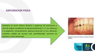 Asimetría en tercio inferior derecho a expensas de tumoración a
nivel de ángulo mandibular de aproximadamente 1 x 1 cm, doloroso
a la palpación. Intraoralmente, apertura bucal de 1.5 cm, dentición
completa, palidez de mucosa oral, semihidratada, aumento de
volumen a nivel retromolar.
EXPLORACION FISICA
 
