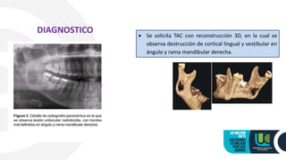 DIAGNOSTICO  Se solicita TAC con reconstrucción 3D, en la cual se
observa destrucción de cortical lingual y vestibular en
ángulo y rama mandibular derecha.
 