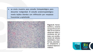  se envía muestra para estudio histopatológico para
descartar malignidad. El estudio anatomopatológico
revela tejidos blandos con infiltración por neoplasia
fusocelular y epitelioide
 