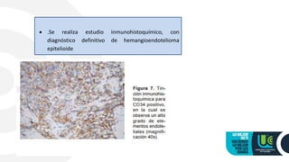  .Se realiza estudio inmunohistoquímico, con
diagnóstico definitivo de hemangioendotelioma
epitelioide
 