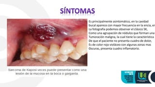 Es principalmente asintomático, en la cavidad
bucal aparece con mayor frecuencia en la encía, en
La fotografía podemos observar el clásico SK,
Como una agrupación de nódulos que forman una
Tumoración maligna, la cual tiene la característica
De que el paciente no presenta cuadro de dolor,
Es de color rojo violáceo con algunas zonas mas
Oscuras, presenta cuadro inflamatorio.
 