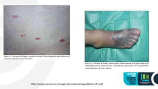 https://www.menarini.es/images/dermatopatologia/Derma135.pdf
 