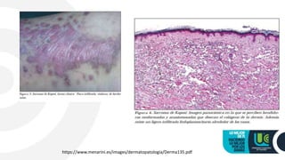 https://www.menarini.es/images/dermatopatologia/Derma135.pdf
 