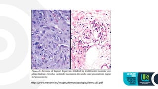 https://www.menarini.es/images/dermatopatologia/Derma135.pdf
 