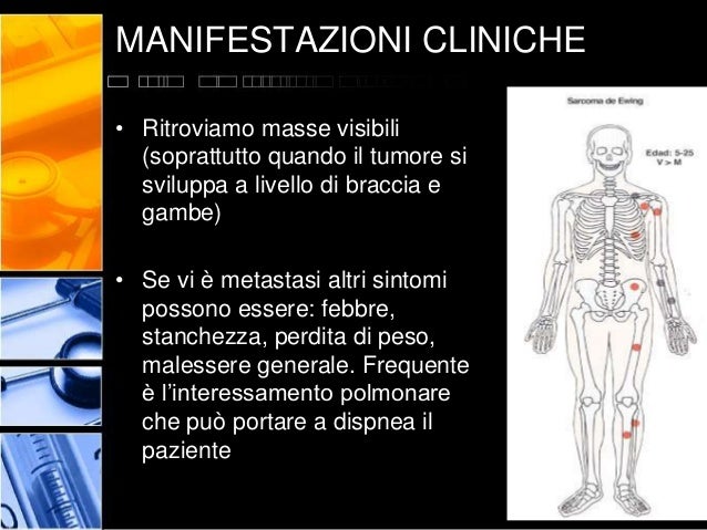 Sarcoma Di Ewing Bulbo Di Cipolla