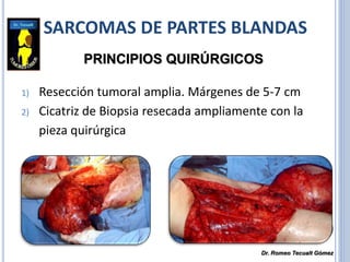 SARCOMAS DE PARTES BLANDAS
1) Resección tumoral amplia. Márgenes de 5-7 cm
2) Cicatriz de Biopsia resecada ampliamente con la
pieza quirúrgica
PRINCIPIOS QUIRÚRGICOS
Dr. Romeo Tecualt Gómez
 