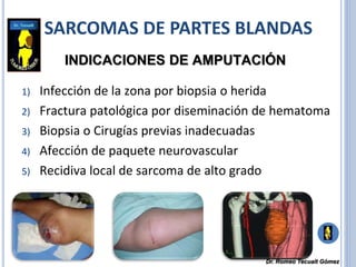 SARCOMAS DE PARTES BLANDAS
INDICACIONES DE AMPUTACIÓN
1) Infección de la zona por biopsia o herida
2) Fractura patológica por diseminación de hematoma
3) Biopsia o Cirugías previas inadecuadas
4) Afección de paquete neurovascular
5) Recidiva local de sarcoma de alto grado
Dr. Romeo Tecualt Gómez
 
