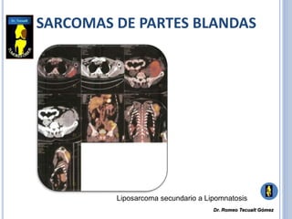 SARCOMAS DE PARTES BLANDAS
Liposarcoma secundario a Lipomnatosis
Dr. Romeo Tecualt Gómez
 