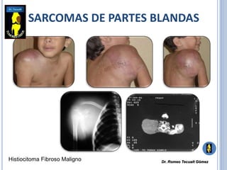 SARCOMAS DE PARTES BLANDAS
Histiocitoma Fibroso Maligno Dr. Romeo Tecualt Gómez
 