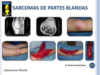 SARCOMAS DE PARTES BLANDAS
Liposarcoma Mixoide
Dr. Romeo Tecualt Gómez
 