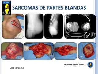 SARCOMAS DE PARTES BLANDAS
Liposarcoma
Dr. Romeo Tecualt Gómez
 
