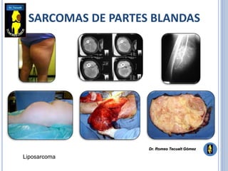 SARCOMAS DE PARTES BLANDAS
Liposarcoma
Dr. Romeo Tecualt Gómez
 
