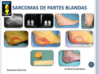 SARCOMAS DE PARTES BLANDAS
Sarcoma Sinovial
Dr. Romeo Tecualt Gómez
 