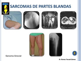 SARCOMAS DE PARTES BLANDAS
Sarcoma Sinovial
Dr. Romeo Tecualt Gómez
 