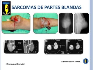 SARCOMAS DE PARTES BLANDAS
Sarcoma Sinovial
Dr. Romeo Tecualt Gómez
 