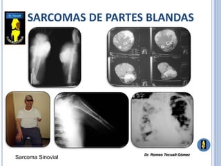 SARCOMAS DE PARTES BLANDAS
Sarcoma Sinovial
Dr. Romeo Tecualt Gómez
 