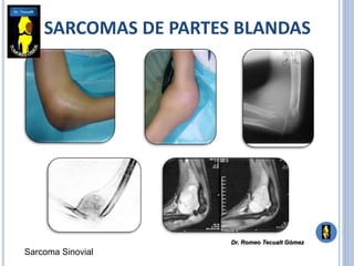 SARCOMAS DE PARTES BLANDAS
Sarcoma Sinovial
Dr. Romeo Tecualt Gómez
 