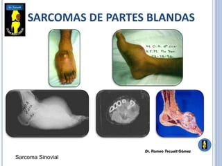 SARCOMAS DE PARTES BLANDAS
Sarcoma Sinovial
Dr. Romeo Tecualt Gómez
 