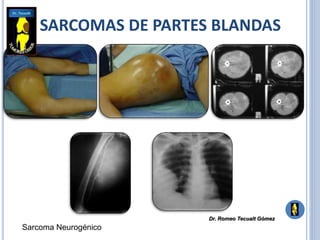 SARCOMAS DE PARTES BLANDAS
Sarcoma Neurogénico
Dr. Romeo Tecualt Gómez
 