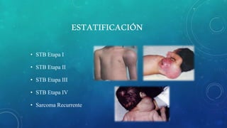 ESTATIFICACIÓN
• STB Etapa I
• STB Etapa II
• STB Etapa III
• STB Etapa IV
• Sarcoma Recurrente
 