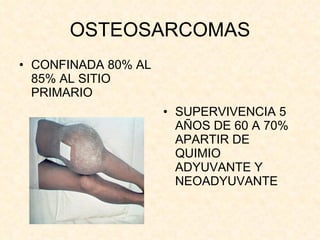 OSTEOSARCOMAS CONFINADA 80% AL 85% AL SITIO PRIMARIO SUPERVIVENCIA 5 AÑOS DE 60 A 70% APARTIR DE QUIMIO ADYUVANTE Y NEOADYUVANTE 