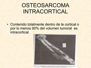 OSTEOSARCOMA INTRACORTICAL Contenido totalmente dentro de la cortical o por lo menos 90% del volumen tumoral  es intracortical. 