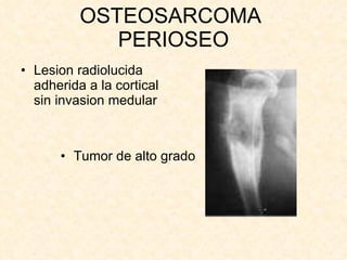OSTEOSARCOMA  PERIOSEO Lesion radiolucida adherida a la cortical sin invasion medular Tumor de alto grado 